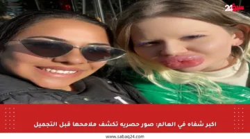 أكبر شفاه في العالم: صور حصرية تكشف ملامحها قبل التجميل